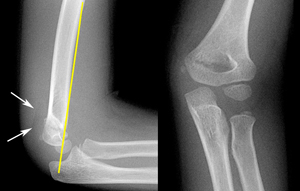 Fracture-Supracondylar_Gartland-1_Lat-and-AP-Figure-1_1212645-.jpg