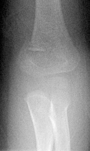 Fracture-Supracondylar_Gartland_II_AP-Figure-2_1373652.jpg