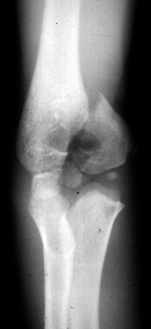 Medial_epicondyle_ED_Section6_Box_humerus_x-ray.jpg