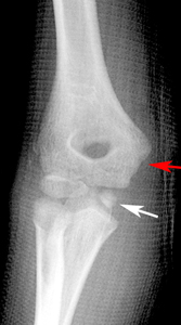 Clinical Practice Guidelines Medial Epicondyle Fracture Of The Humerus Emergency Department