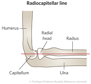 Olecranon_fracture_ed_section6_radiocapitellar_line_lat.jpg