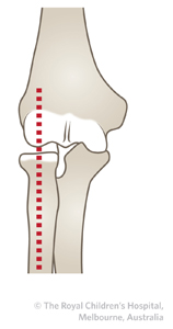 Olecranon_fracture_ed_section6_radius_capitellum_line_ap.jpg