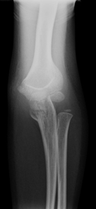 Olecranon_fracture_figure2_combined_fractureap.jpg