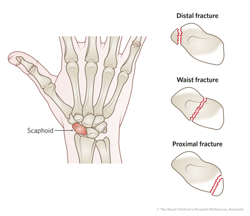 Scaphoid Fracture Types Wrist Fracture Risk Factors Treatment And Scaphoid Fracture Types Wrist Fracture Risk Factors Treatment And