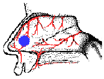 epistaxis pic