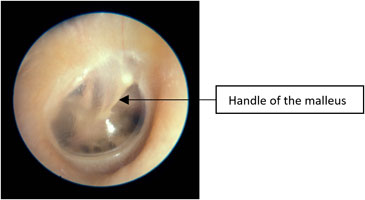 Effectiveness of corticosteroids in otitis media with effusion: an