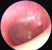 Pink Tympanic Membrane