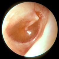 Otitis Media with Effusion (OME) glue ear