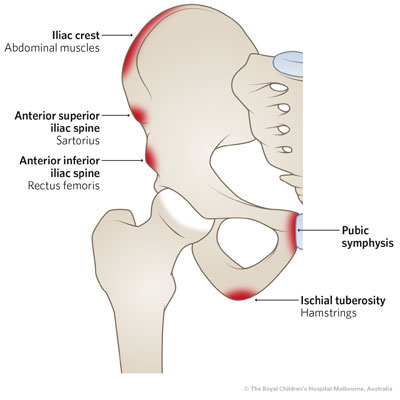 Clinical Practice Guidelines : Apophysitis of the Pelvis and Hip