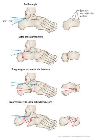 Clinical Practice Guidelines : Calcaneus Fractures - Emergency Department