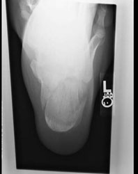 articular fracture, lateral and Harris views