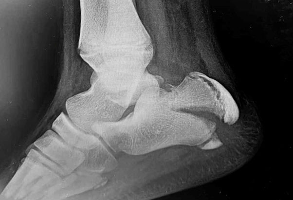 Lateral radiograph of the right foot following trauma. X-ray shows the... |  Download Scientific Diagram