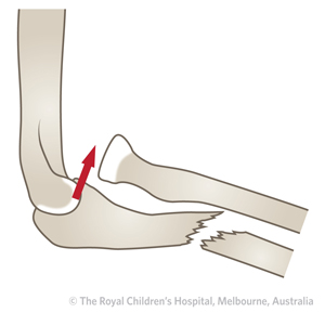 Clinical Practice Guidelines Monteggia Fracture Dislocations