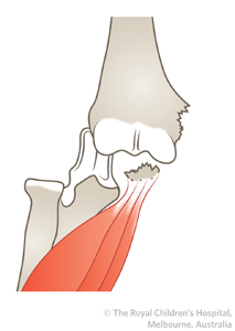 clinical practice guidelines medial epicondyle fracture of the