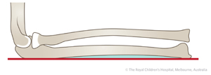 Clinical Practice Guidelines : Radius - ulna shaft ...