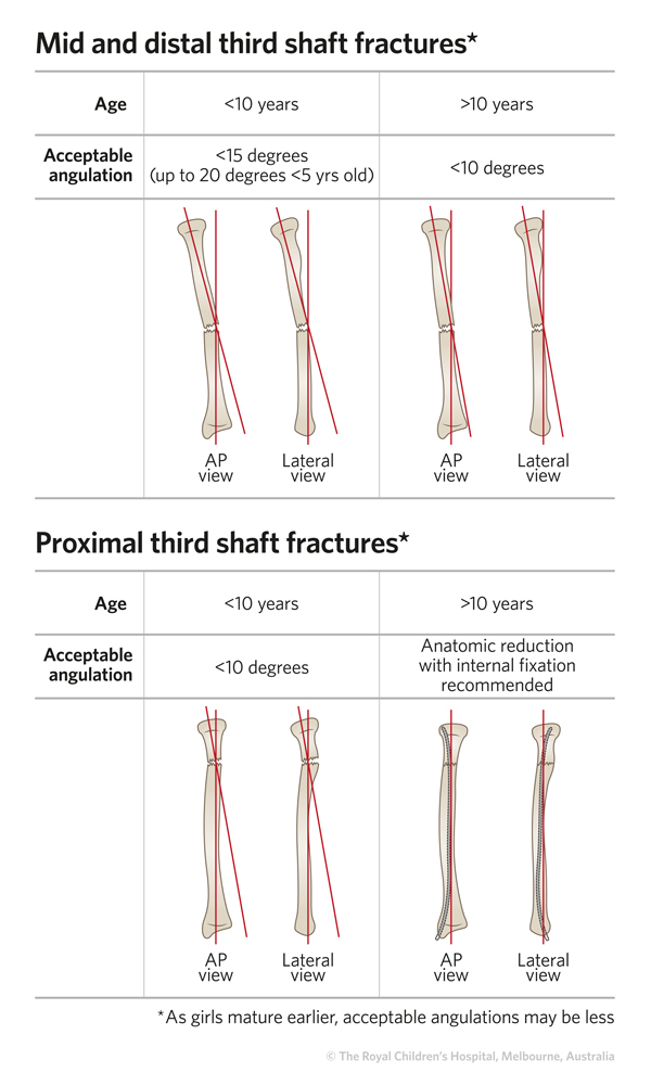 Clinical Practice Guidelines : Radius - ulna shaft diaphysis fractures -  Emergency Department