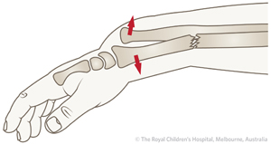 ED_Section_2_GALEAZZI_FRACTURE_dorsal.jpg