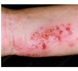 Eczema image 1.1