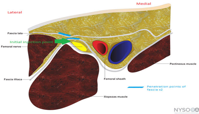 Femoral nerve block