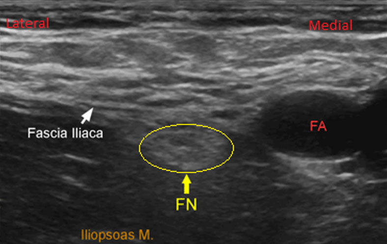 Femoral nerve block 2