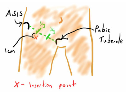 Femoral nerve block 3