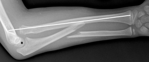 Figure 1_1372210_Monteggia Type 1_Ulna Shaft_Lat.jpg