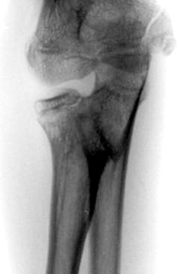 Figure 4_Olecranon-synostosis3.jpg