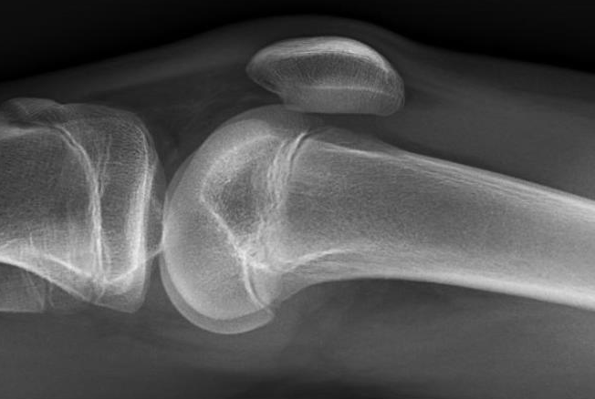 Figure 1 moderate haemarthrosis