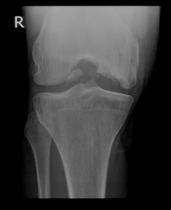 Figure 4 Acute os eochondral defect