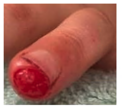 Fingertip-and-nail-injuries-10