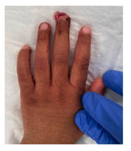 Fingertip-and-nail-injuries-11