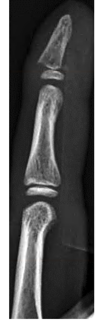 Fingertip-and-nail-injuries-3-1
