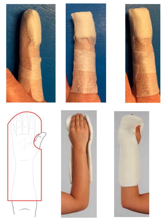 Fingertip-and-nail-injuries-4