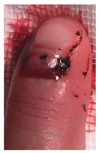 Fingertip-and-nail-injuries-5