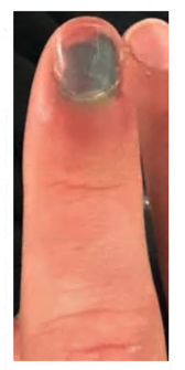 Fingertip-and-nail-injuries-6