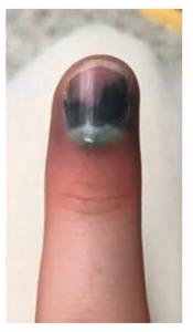 Fingertip-and-nail-injuries-7