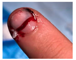 Fingertip-and-nail-injuries-8
