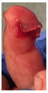 Fingertip-and-nail-injuries-9