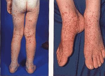 Typical rash distribution