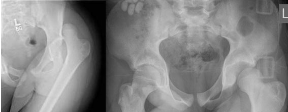 Posterior dislocation of the left hip in two different patients