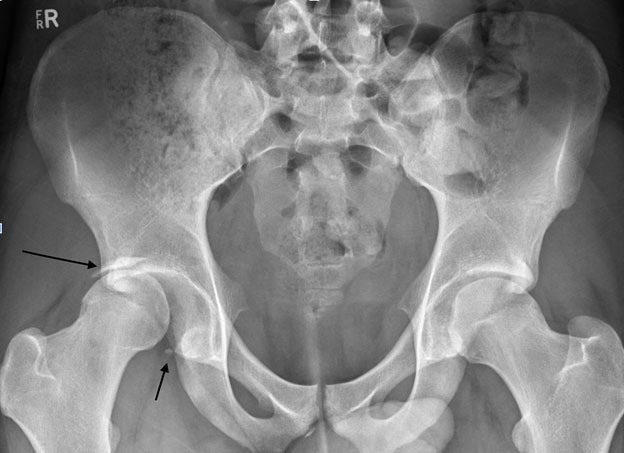     Posterior dislocation right hip with fracture of the bony acetabular rim both superiorly (long arrow) and inferiorly (short arrow)