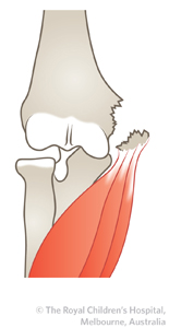 Medial_epicondyle_ED_Section1_5to15mm.jpg