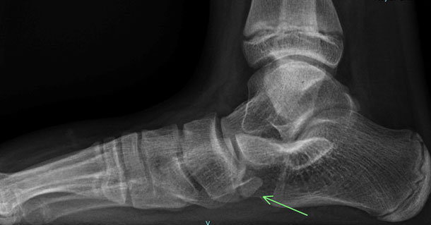 What Is A Navicular Stress Fracture Ph