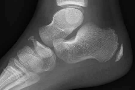 Dorsal avulsion fracture