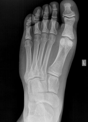 Navicular Body fracture
