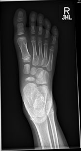 Kohler disease, with flattening and sclerosis of the Navicular