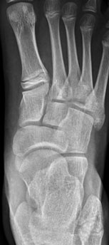 Accessory Navicular shown on the first image