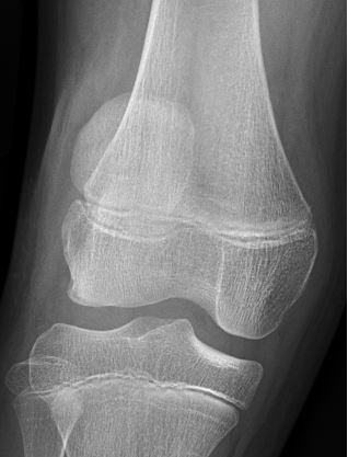 Lateral subluxation of patella alta