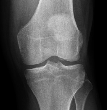 Patellar slightly subluxated and osteochondral lesion below lateral condyle in the joint.