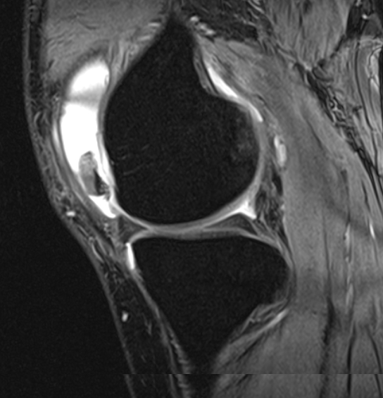 Large osteochondral fragment anterior aspect of knee on MRI